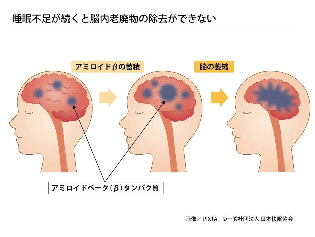 寝不足 認知 症